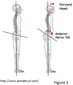 Anterior Pelvic Tilt, Femoroacetabular Impingement, Portland Physical Therapy, Physical Therapy.
